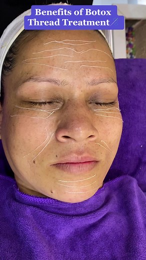 Discover Botox Thread Treatment at Zoom Beauty Academy