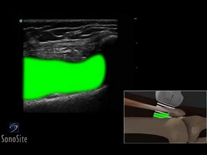 How to: Ultrasound Guided Injection of the Lateral Knee 3D Video