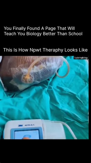 Anatomy | Physiology | Body facts on Instagram: "This is how NPWT (Negative Pressure Wound Therapy) looks like 👇 NPWT, also known as vacuum-assisted wound therapy, uses controlled suction to help wounds heal faster and more effectively. A sealed dressing is placed over the wound and connected to a pump that gently removes excess fluid, reduces swelling, improves blood flow, and encourages healthy tissue growth. It’s widely used for chronic wounds, surgical incisions, burns, and trauma care—quie