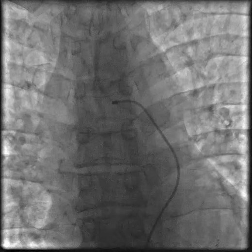 L'embolizzazione delle arterie bronchiali