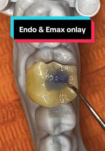 Deep Cavity Treatment: Endo & Emax Overlay Explained