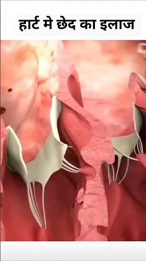 How to Fix a Hole in the Heart - Animated Explanation