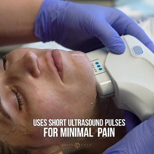 Ultherapy for Loose Skin