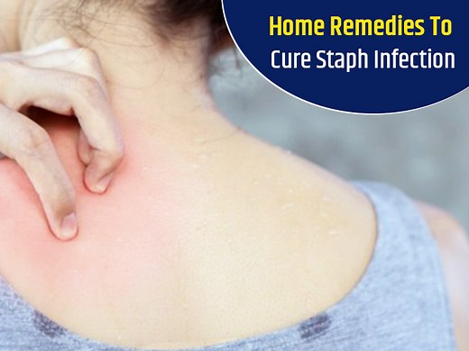 Try Out These 5 Home Remedies To Cure Staph Infection