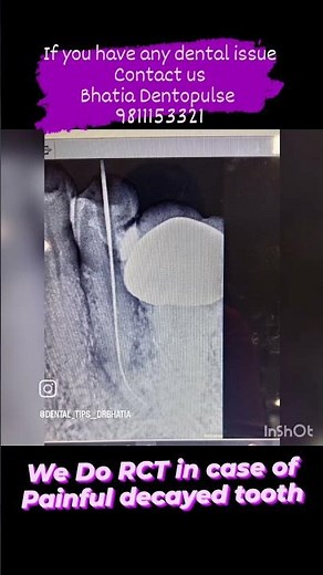 Steps of RCT animated #rct #rct #rootcanalfilling #rootcanalretreatment #dentalimplants