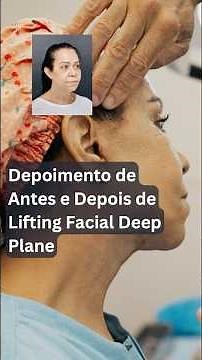 Antes e Depois Lifting Facial Deep Plane: Resultado Natural em 1 Mês | Depoimento Real