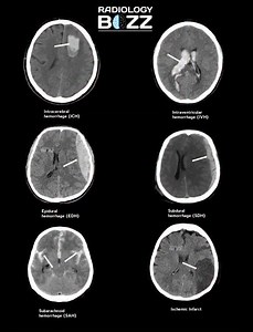 🧠 CT Brain Emergencies at a Glance | Radiology Buzz 🧠 This composite non-contrast CT brain image beautifully demonstrates the major types of acute intracranial pathologies every radiology professional must instantly recognize in emergency settings: 🔹 Intracerebral Hemorrhage (ICH) – Hyperdense bleed within the brain parenchyma, commonly associated with hypertension. 🔹 Intraventricular Hemorrhage (IVH) – Blood layering within the ventricular system, often extending from ICH or SAH. 🔹 Epidura