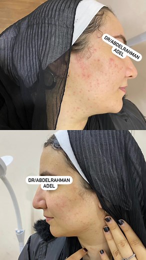 23K views · 30 reactions | الجمال في التفاصيل، وإحنا هنا علشان نبرز تفاصيل جمالك 殺ولسه العروض شغالة خصم 50٪ علي كل الجلسات 殺مستني إيه؟ إحجز دلوقتي قبل ما العروض تنتهي!للحجز والاستفسار :01120816991 | Dr/Abdelrahman Adel | Facebook