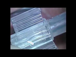 WIOL-CF implantation after LCS