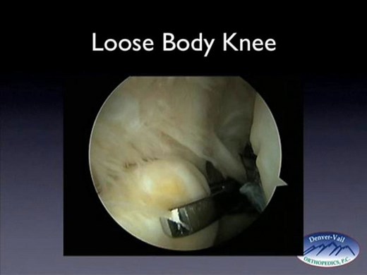 Loose Body Knee Surgery