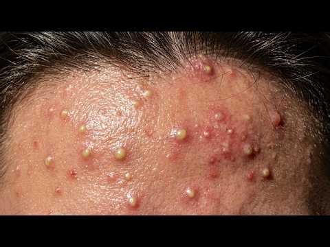 Loan Nguyen Acne Treatment 43kk