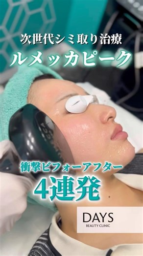 【シミ治療】衝撃ビフォーアフター4連発！#shorts