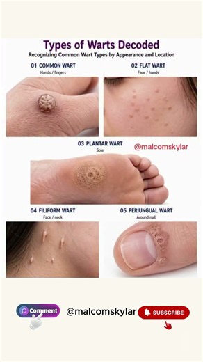 Plantar, Common & Genital Warts: What’s the Difference?