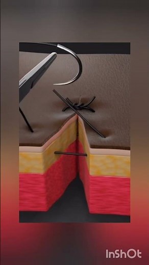 “Mastering the Simple Interrupted Suture | Essential Surgical Skill 🧵✨”---