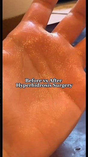 Before v After Hyperhidrosis Surgery for excessively sweaty hands #excessivesweating #hyperhidrosis