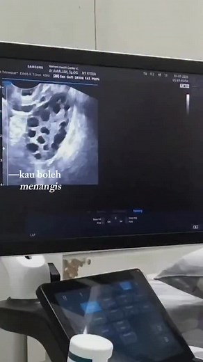 22K views · 1.1K reactions | Ini adalah hasil USG transvaginal ini...
