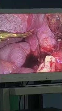 दुरबीन appendix surgery Laparoscopic method 🩺🏥