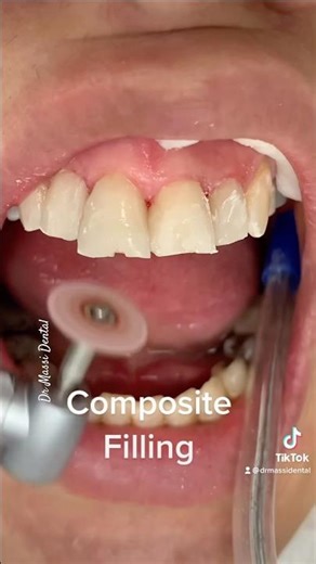 Front Teeth Reshaping 🤩