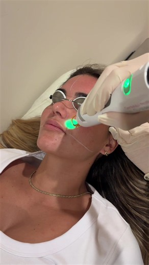 Candela Laser Collagen Facial: Non‑Surgical Skin Tightening