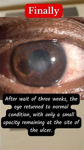 The Shocking Truth About Corneal Ulcer Recovery You Need to Know NOW