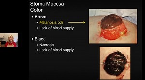 Ostomy 101: 5 Key Steps for an Accurate Stoma Assessment Recorded Webinar