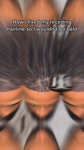 How I fixed my receding hairline so I wouldn’t go bald. Here are 10 things I did to get thicker and fuller hair growth. Growing your hair requires the right strategy. Choose wisely. #hairline #thinninghair #recedinghairline #hairgrowth