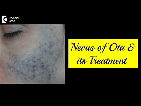 NEVUS OF OTA:What is it and How is it Treated?| Skin Pigmentation-Dr.Rajdeep Mysore| Doctors' Circle