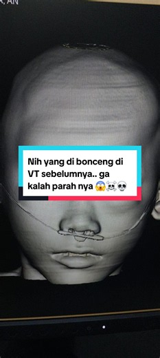 Ini teman yang di bonceng pada Vt saya sebelum ini.. kecelakaan motor.. mengalami fraktur pada area tulang frontal #ctscan #3D #radiologi #ckb
