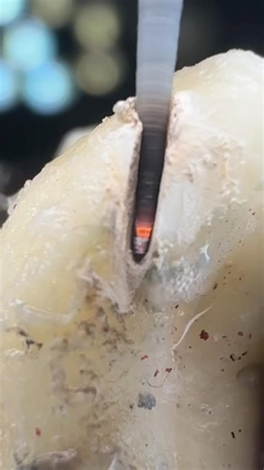 Inside the Tooth 🔥 Precision Dental Work | Stasik #Shorts #automobile #rock #rock #satisfying #song