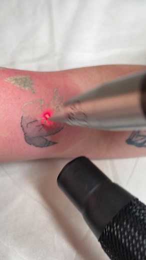 Tattoo Removal Process: Before and After Results