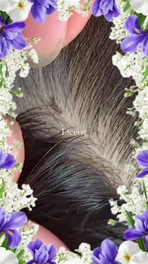 How to Remove Head Lice Safely and Effectively