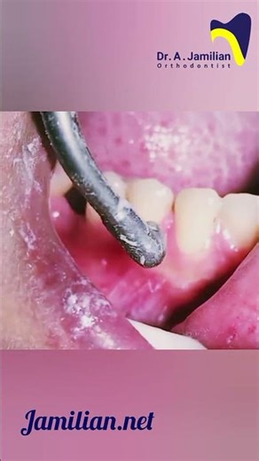 Water Jet Teeth Cleaning | Ultrasonic Scaling for Tartar & Plaque Removal#dentist #Water_jet#scaling