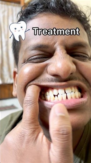 My First Professional Teeth Cleaning! 🦷 (The Results) #Shorts #dental #teeth