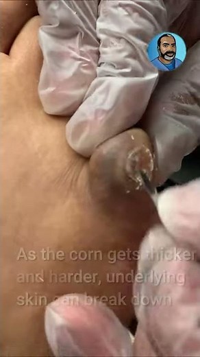 Hidden Ulcer Beneath A Corn On The Fifth Toe: Shorts