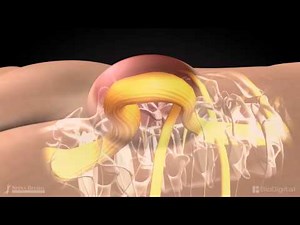 Spina Bifida Animation