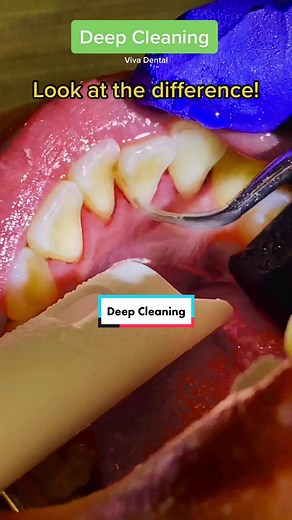 Satisfying Deep Cleaning for Teeth