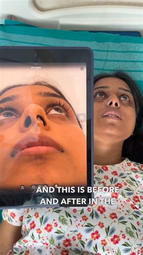 Praaya Aesthetics | Rhinoplasty & Cosmetic Surgery centre on Instagram: "Caudal septum correction ✅ #septoplasty #praayaaestheticclinic #cosmeticsurgery #nosejob #caudalseptum"