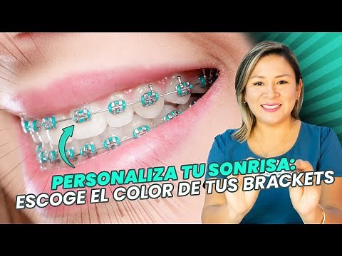 Braces Colors: Which Is Best For You?
