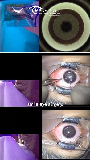 How SMILE Eye Surgery Is Done | Step-by-Step SMILE Procedure Explained | Envision Lasik Centre