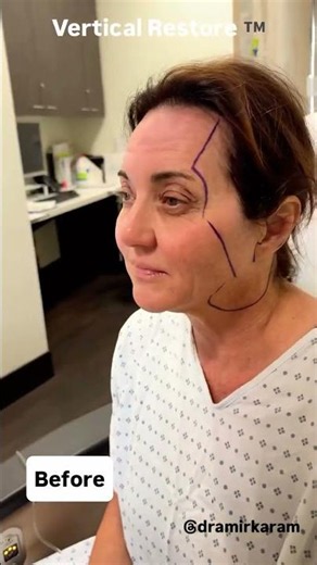 Day 1 After a Facelift: What Healing Really Looks Like (58 Years Old)