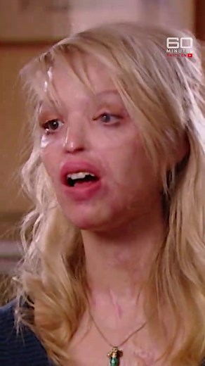 Katie Piper's Inspiring Transformation After Acid Attack