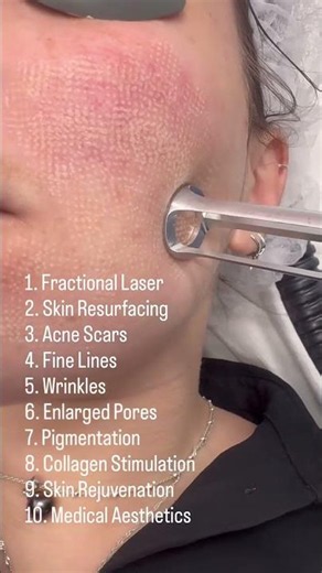 Fractional Laser Skin Resurfacing : How It Actually Works ✨