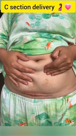 c section delivery 🤰💗👣#shorts #pregnancy #video