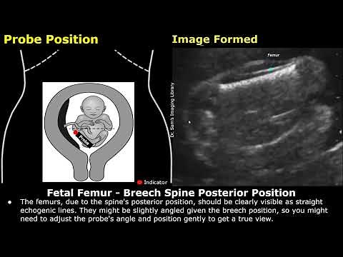 Fetal Femur Ultrasound Probe Positioning & Image Formation | FL USG Scanning Technique & Orientation