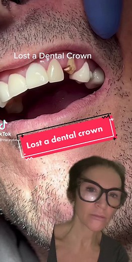 🙈Lost a dental crown - nothing to hold it too? 👀What can you do In this case we placed a new post and Core and recemented the original crown 🥹Broke on a toffee 😊Fixed by a dentist #losttooth #recementatooth #toothadvisor #lostdentalcrown #lostcrown #replaceatooth #zirconiumcrowns #postandcrown #recementacrown #toothadvice#emergencydentist #emergencydental #emergencydentistry