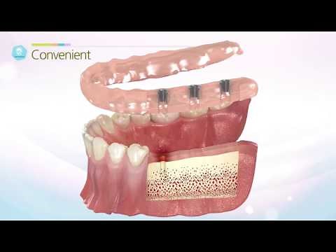 DENTIS Dental Guide System - Simple Guide