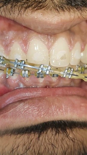braces removal #dentist #world #viral #shorts