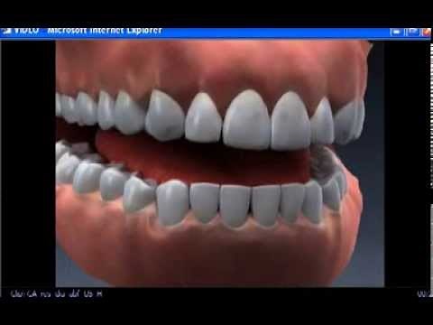 Abfractions Downey dental dentist 562 869 0928