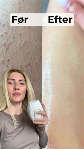 ☀️ Sommerudsalg - spar 56% på IPL hårfjerning Bliv hårfri eller få pengene retur... 👀 👋 Sig farvel til barbering, røde knopper, indgroede hår og irriterende stubbe med IPL fra AVA. ✅ 90% reduktion i hårvækst indenfor 8 uger, eller pengene tilbage. Køb og få GRATIS forsendelse. | Krop & Sundhed