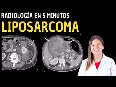 Liposarcoma: Radiología en 5 minutos.